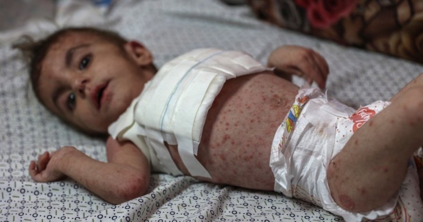 Dangerous skin diseases spreading among children in Gaza