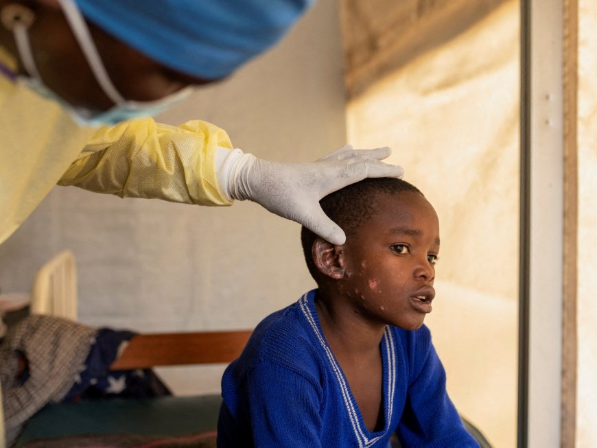 Sweden confirms first case of mpox strain outside Africa